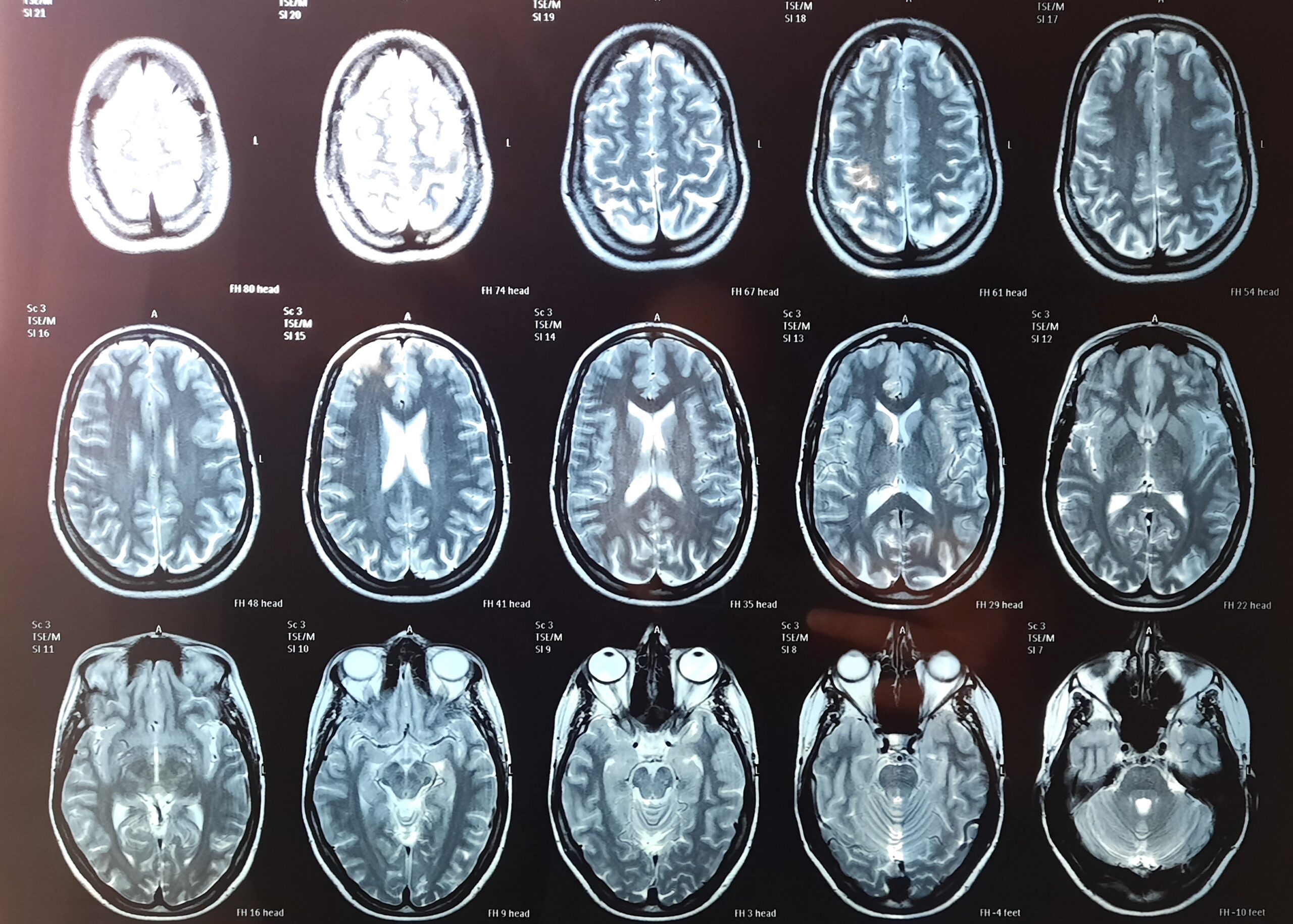 MRT Bilder von Rosis Gehirn